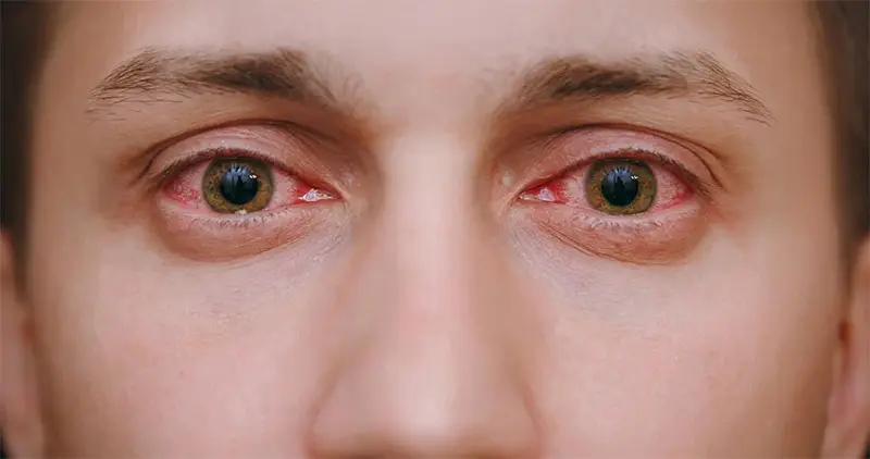 Olhos vermelhos: causas e tratamentos