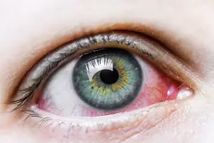 Hiperemia conjuntival Hiperemia conjuntival